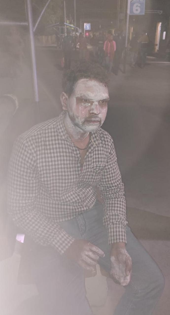 अंजान युवती ने युवक के चेहरे पर मुँह में भरा पेट्रोल छिड़क कर लाइटर से लगाई आग