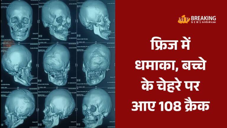 15 साल पुराने फ्रिज में धमाका, 14 वर्षीय लड़के के चेहरे में आए 108 जगह क्रैक, जबलपुर में हुई जटिल सर्जरी