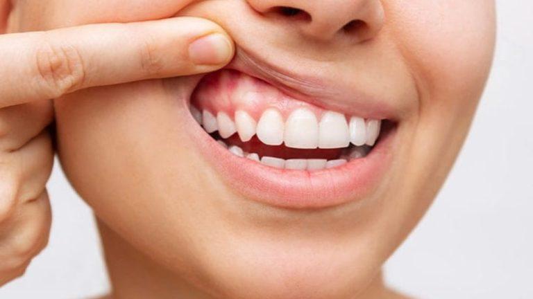 Oral Health: महंगे टूथपेस्ट से नहीं मिल रहा आराम? नीम और लौंग से घर पर बनाएं नेचुरल मंजन, जानें विधि