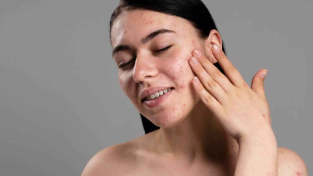 पिंपल्स फुटून चेहऱ्यावर खड्डे आणि डाग पडलेत? 'हे' घरगुती उपाय नितळ बनवतील त्वचा