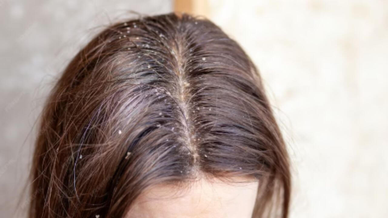 केसांमधील कोंडा कसा दूर करावा? 'हे' आहेत सोपे घरगुती उपाय