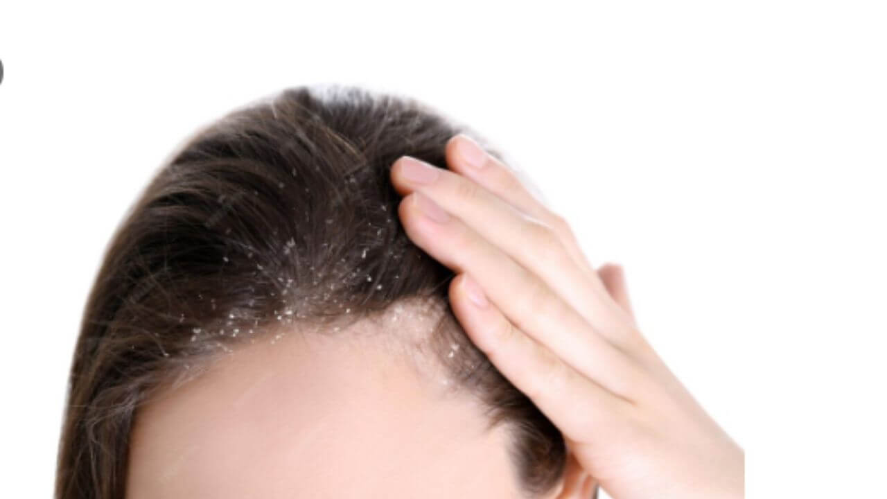 केसांमध्ये सतत का होतो कोंडा? जाणून घ्या कारणे आणि घरगुती उपाय