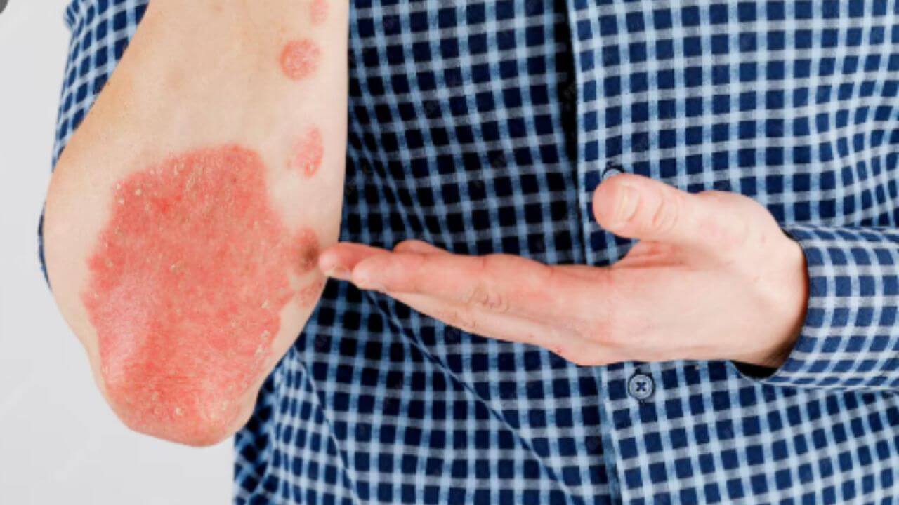 फंगल इन्फेक्शनमुळे त्वचेला खाज सुटून त्वचेची आग होतेय? 'हे' घरगुती उपाय देतील आराम