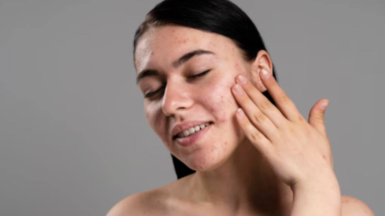 चेहेऱ्यावर सतत पिंपल्स येऊ नयेत म्हणून काय करावे? 'या' सोप्या टिप्स फॉलो करा