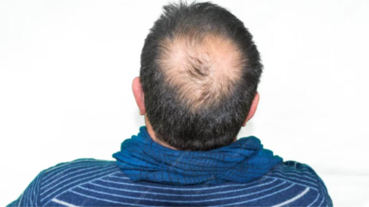 पुरुषांनी केस गळतीसाठी काय करावे? 'हे' आहेत सोपे आयुर्वेदिक उपाय