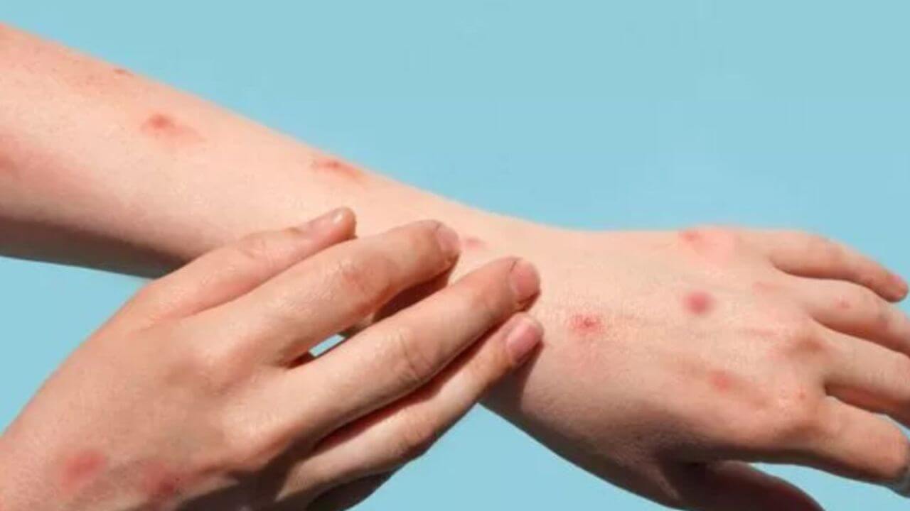 सावधान! महाराष्ट्रात मंकी पॉक्सचा शिरकाव; पहिला रूग्ण आढळला, प्रशासन अलर्टवर