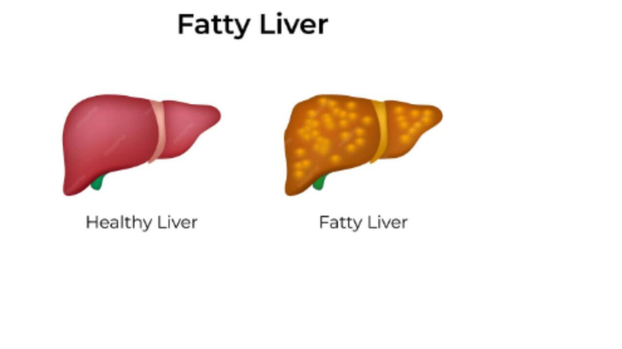 फॅटी लिव्हरची समस्या त्रास देतेय? 'हे' आयुर्वेदिक उपाय देतील आराम