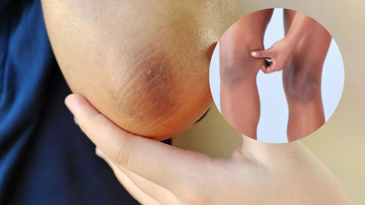 तुमचेही गुडघे, घोटे किंवा कोपरही काळे झालेत? ' या' घरगुती उपायाने मिळेल एकसारखी नितळ त्वचा