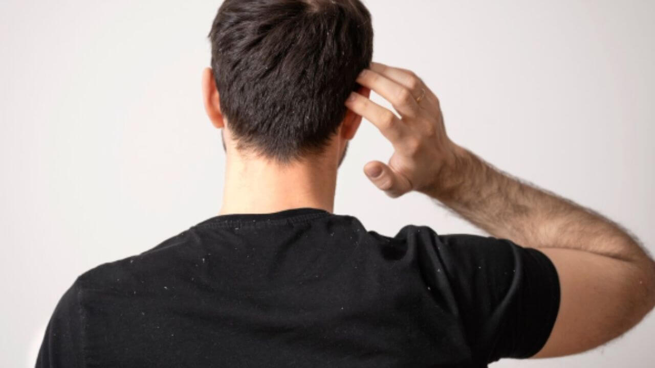 हिवाळ्यात केस निस्तेज होऊन डोक्यात कोंडा झालाय? 'हे' सोपे उपाय दूर करतील समस्या