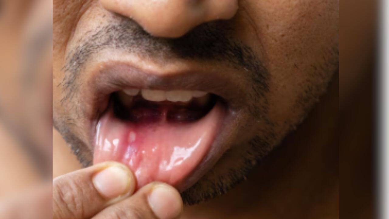 तोंडात फोड आल्याने काहीही खातापिता येत नाहीय? 'या' घरगुती उपायाने मिळेल आराम