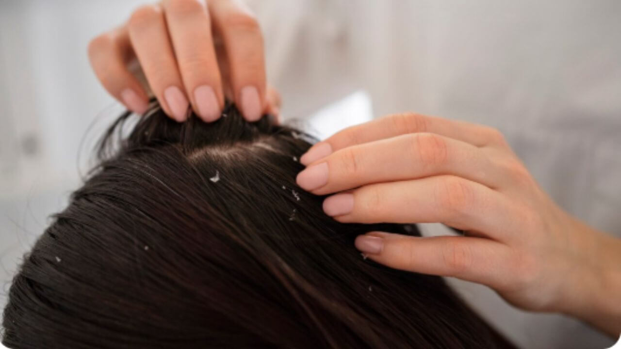 हिवाळ्यात केसांमध्ये फारच कोंडा होतोय, कमी करण्यासाठी जाणून घ्या सोपे उपाय