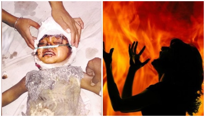 alirajpur-blind-woman-burnt-by-putting-kerosene-on-face