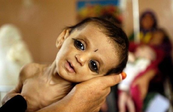 when-will-malnutrition-free-capital-bhopal