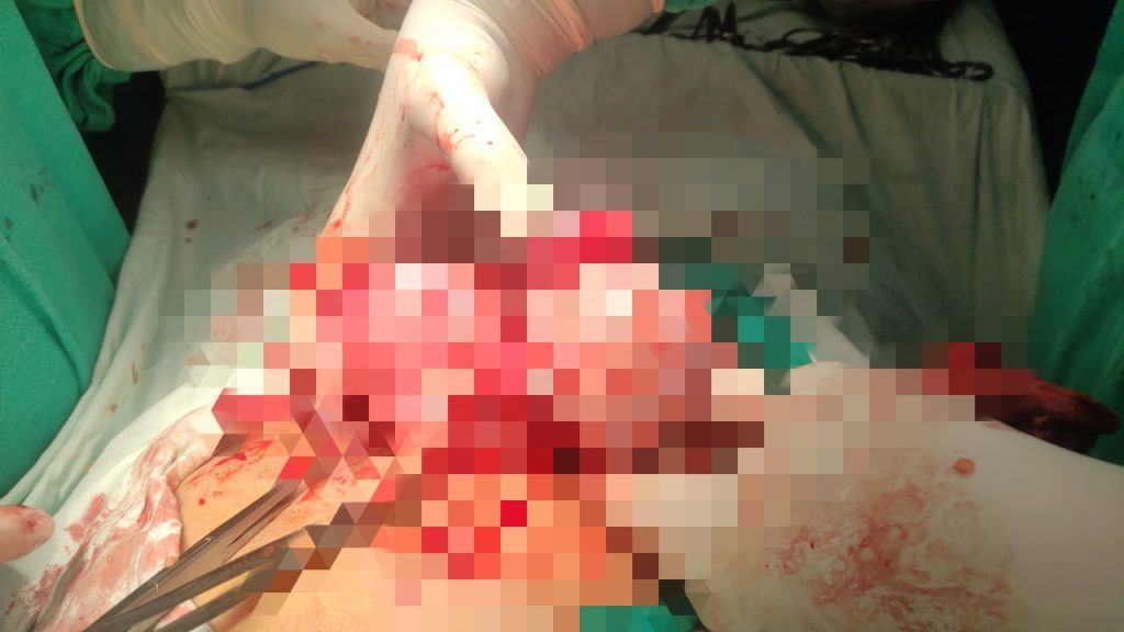 एम. वाय. अस्पताल के डॉक्टरों किया करिश्मा,महिला के पेट निकाली 57 छोटी बड़ी गठाने
