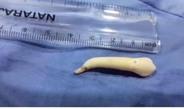 MP में डॉक्टरों ने एक मरीज के जबड़े से निकाला दुनिया का सबसे लंबा दांत