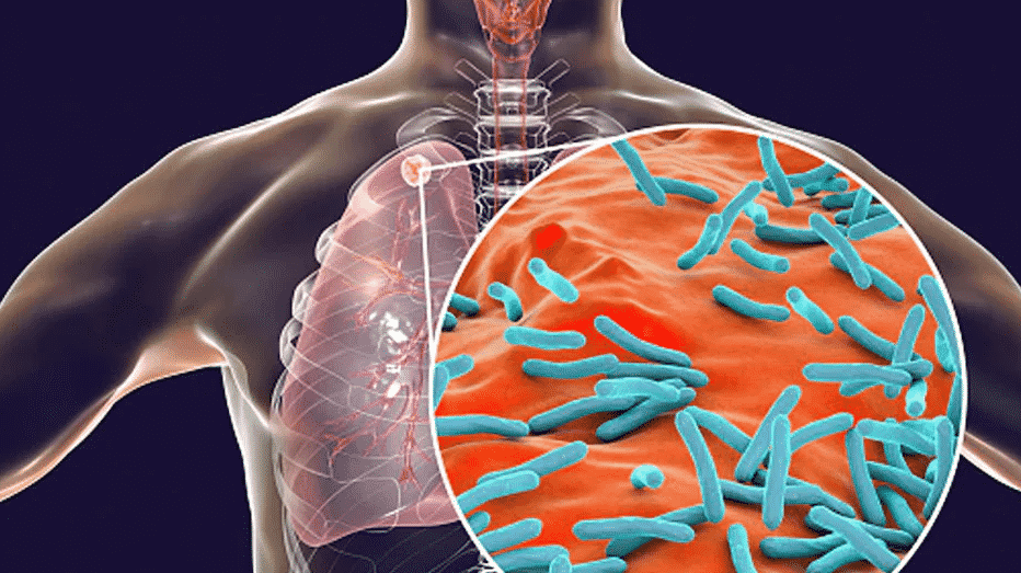 कोरोना संक्रमण के बाद पोस्ट कोविड मरीजों के फेफड़ों में मिल रहा टीबी का खतरा