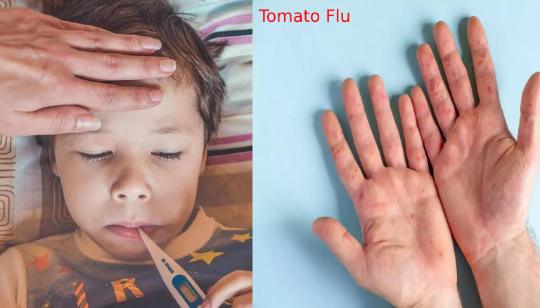 कोरोना वायरस के बाद Tomato फ्लू ने दिया दस्तक, 80 से ज्यादा बच्चे संक्रमित, अभी जानें इसके लक्षण