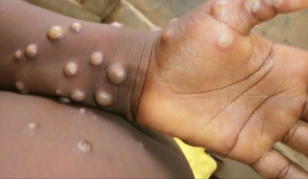 भारत में Monkeypox की दस्तक! 5 साल की बच्ची में दिखे इस वायरस के लक्षण, जांच के लिए भेजे गए सैम्पल