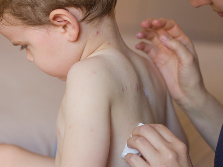 Monkeypox: बच्चों को लिए यह वायरस अधिक खतरनाक, ICMR ने किया अलर्ट, जाने कैसे करें बचाव