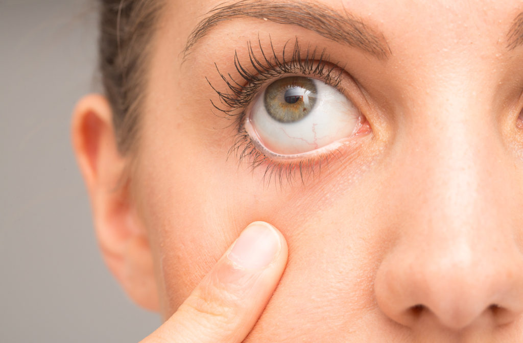 Contact Lens Side Effects