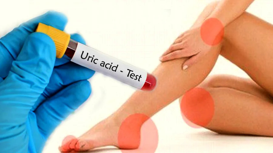 Health Tips : Uric Acid को काबू में करने के लिए अपनाएं ये आसान रूटीन और समस्या से जल्द पाएं निजात