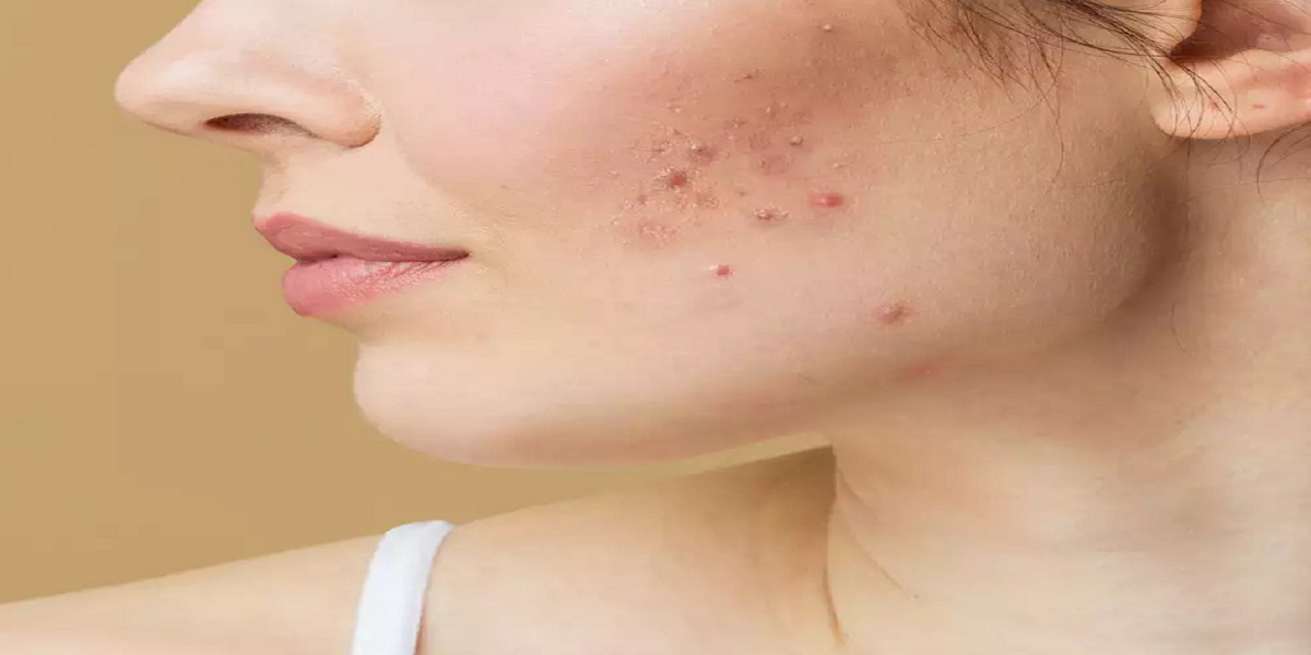 Pimples Tips: पिंपल की समस्या से हैं परेशान, तो जल्द करें ये घरेलू उपाय और हमेशा के लिए पाएं निजात