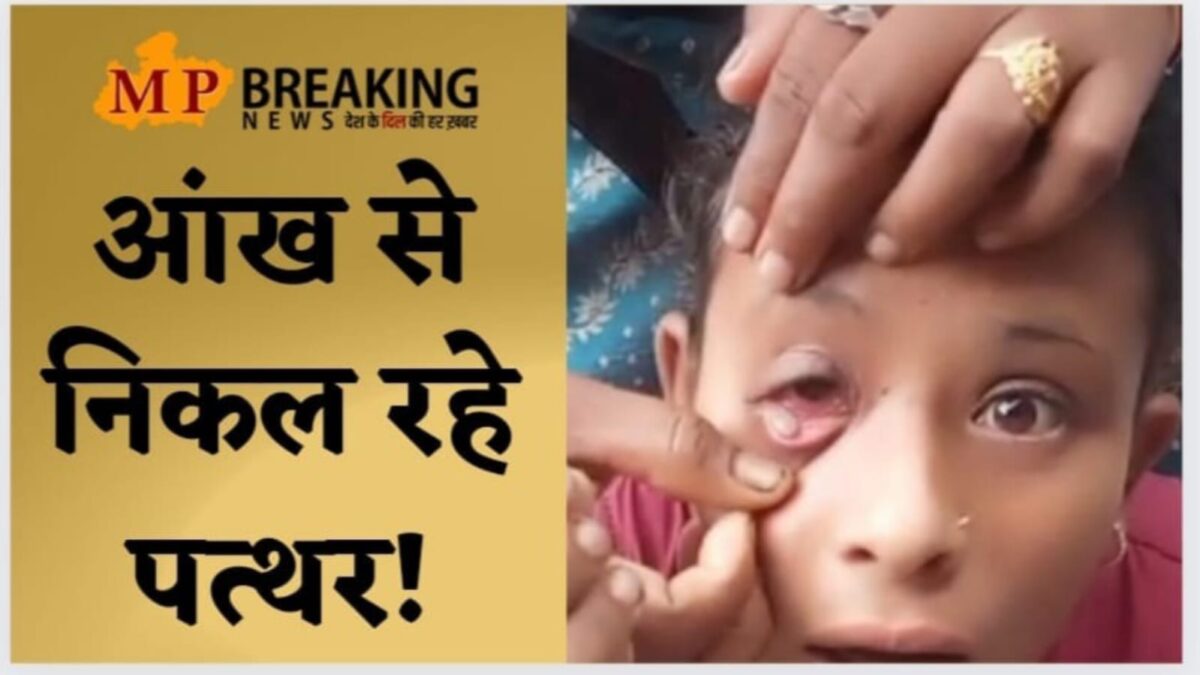 MP News : बच्ची की आंख से निकल रहे पत्थर! डॉक्टर भी हैरान, क्षेत्र में हो रही तरह तरह की चर्चाएं