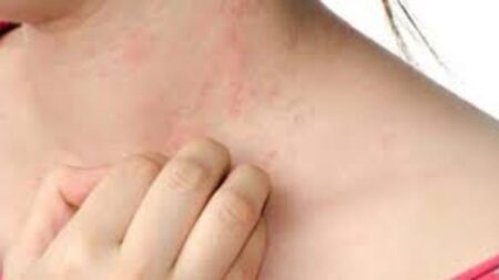 Skin Rashes: स्किन एलर्जी की समस्या से इस तरह पाएं छुटकारा, अपनाएं ये 4 टिप्स