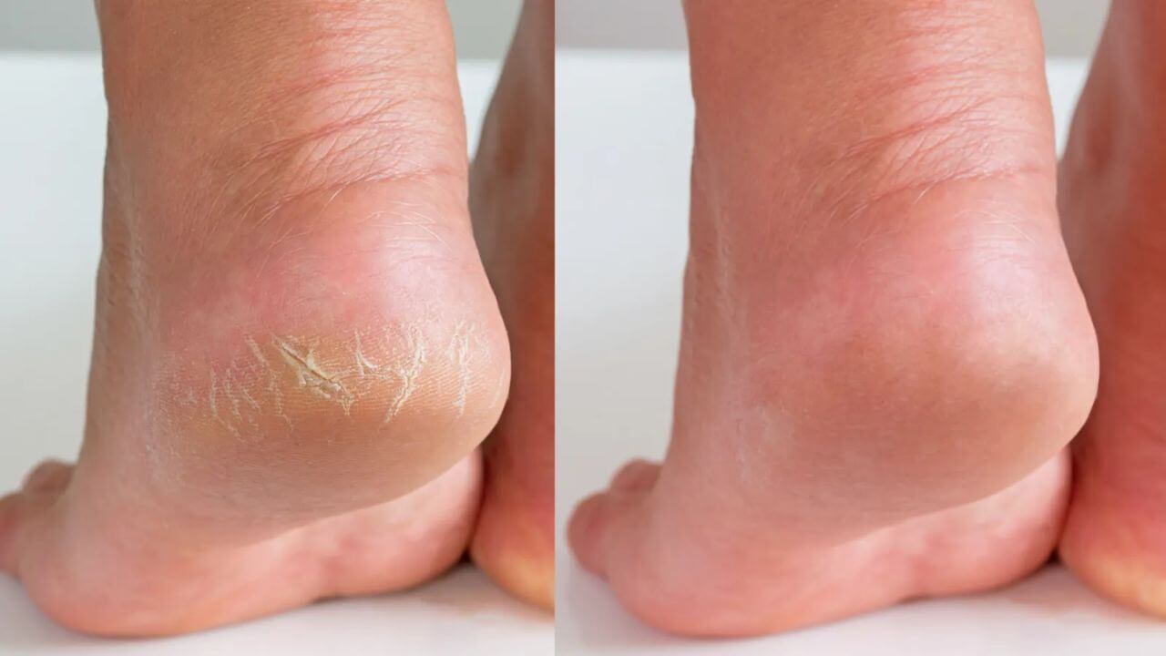 Dry Cracked Heels Treatment